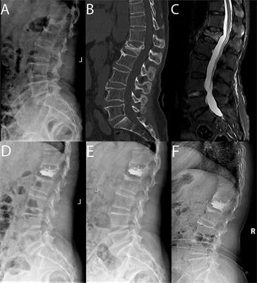 Comparison of Percutaneous Kyphoplasty With or Without Posterior Pedicle Screw Fixation on Spinal Sagittal Balance in Elderly Patients With Severe Osteoporotic Vertebral Compression Fracture: A Retrospective Study